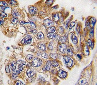 IHC analysis of FFPE human lung carcinoma tissue stained with GRB2 antibody~