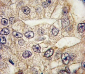 IHC analysis of FFPE human lung carcinoma tissue stained with CD14 antibody