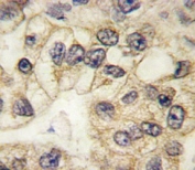 CD14 antibody used to stain FFPE human lung carcinoma