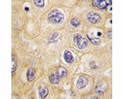 IHC analysis of FFPE human hepatocarcinoma tissue stained with Claudin 1 antibody.~
