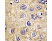 IHC analysis of FFPE human hepatocarcinoma tissue stained with Claudin 1 antibody.