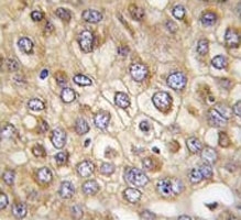 IHC analysis of FFPE human hepatocarcinoma tissue stained with Claudin 2 antibody~