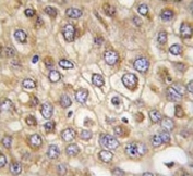 IHC analysis of FFPE human hepatocarcinoma tissue stained with Claudin 2 antibody