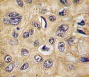 IHC analysis of FFPE human hepatocarcinoma tissue stained with Tuberin antibody