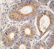 IHC analysis of FFPE human colon carcinoma tissue stained with FGF1 antibody