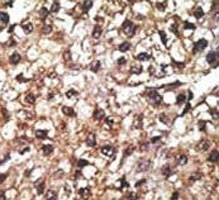 IHC analysis of FFPE human hepatocarcinoma tissue stained with the PINK1 antibody