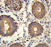 CEA antibody immunohistochemistry analysis in formalin fixed and paraffin embedded human colon carcinoma.