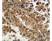 ABCG1 antibody immunohistochemistry analysis in formalin fixed and paraffin embedded human lung carcinoma.