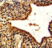 IHC analysis of FFPE human prostate carcinoma with VIP antibody