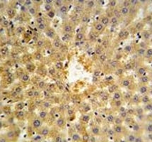 Annexin V antibody IHC analysis in formalin fixed and paraffin embedded human hepatocarcinoma.
