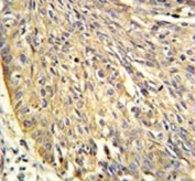 Annexin A1 antibody IHC analysis in formalin fixed and paraffin embedded human lung carcinoma.