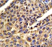 IHC analysis of FFPE human hepatocarcinoma stained with VDAC antibody