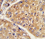 IHC analysis of FFPE human hepatocarcinoma stained with GARP antibody