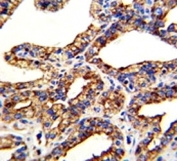 IHC analysis of FFPE human prostate carcinoma with TROP2 antibody