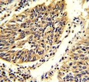 IHC analysis of FFPE human lung carcinoma stained with WNT4 antibody.