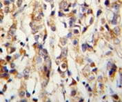 IHC analysis of FFPE human breast carcinoma with Keratin-14 antibody