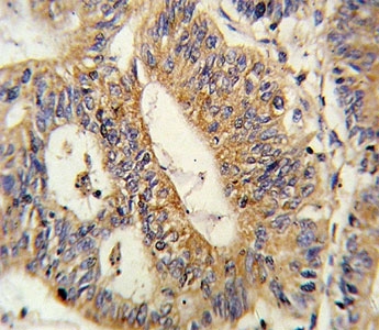 IHC analysis of FFPE human colon carcinoma stained with IL17RB antibody