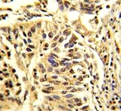 IHC analysis of FFPE human lung carcinoma stained with CEBPB antibody
