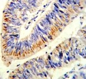 IHC analysis of FFPE human colon carcinoma stained with p65 antibody