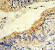IHC analysis of FFPE human colon carcinoma stained with ACADM antibody