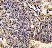 IHC analysis of FFPE human lung carcinoma stained with IL-1 antibody