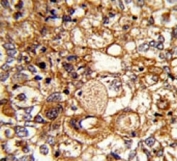IHC analysis of FFPE human breast carcinoma stained with C6 antibody