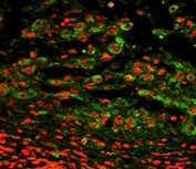 Immunofluorescence analysis of CD11c antibody with paraffin-embedded human hepatocarcinoma. Primary Ab was followed by FITC-conjugated goat anti-rabbit lgG. FITC emits green fluorescence. Red counterstaining is PI.