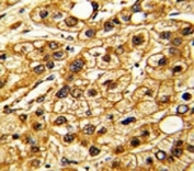 IHC analysis of FFPE human hepatocarcinoma stained with CD11c antibody