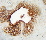 LAG3 antibody immunohistochemistry analysis in formalin fixed and paraffin embedded human prostate carcinoma.