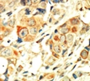 IHC analysis of FFPE human breast carcinoma tissue stained with the PKC alpha antibody