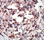 IHC analysis of FFPE human breast carcinoma tissue stained with the PKC beta antibody