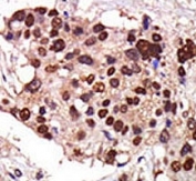 IHC analysis of FFPE human breast carcinoma tissue stained with the PKC nu antibody