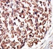 IHC analysis of FFPE human hepatocarcinoma tissue stained with the PKC nu antibody