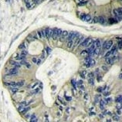 IHC analysis of FFPE human colon carcinoma stained with AKT2 antibody