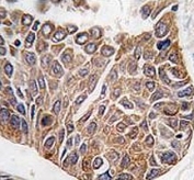 IHC analysis of FFPE human lung carcinoma tissue stained with AKT2 antibody