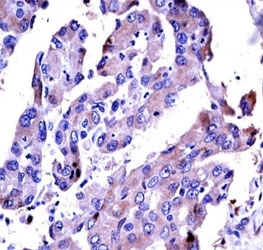 AKT2 antibody immunohistochemistry analysis in formalin fixed and paraffin embedded human lung adenocarcinoma.