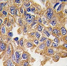 IHC analysis of FFPE human lung carcinoma tissue stained with AKT2 antibody