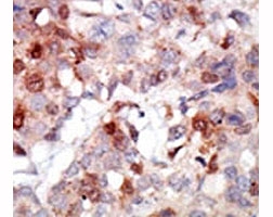 IHC analysis of FFPE human breast carcinoma tissue stained with the AKT3 antibody