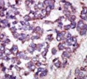 IHC analysis of FFPE human hepatocarcinoma tissue stained with the LATS1 antibody