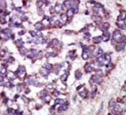 IHC analysis of FFPE human hepatocarcinoma tissue stained with the LATS1 antibody