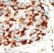 IHC analysis of FFPE human hepatocarcinoma tissue stained with the AMPK beta 1 antibody
