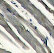 IHC analysis of FFPE human hepatocarcinoma stained with LRRK2 antibody