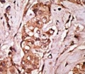 IHC analysis of FFPE human breast carcinoma tissue stained with the LRRK2 antibody