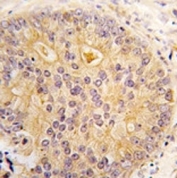 IHC analysis of FFPE human prostate carcinoma tissue stained with CAMKK2 antibody