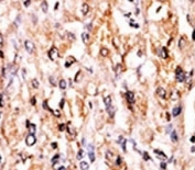 IHC analysis of FFPE human hepatocarcinoma tissue stained with the GCN2 antibody