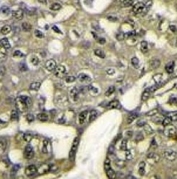 IHC analysis of FFPE human breast carcinoma stained with AKT1 antibody