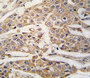IHC analysis of FFPE human breast carcinoma tissue stained with PKM2 antibody~