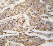 IHC analysis of FFPE human breast carcinoma tissue stained with PKM2 antibody