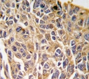 IHC analysis of FFPE human lung carcinoma tissue stained with RIPK3 antibody