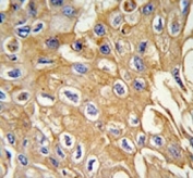 IHC analysis of FFPE human lung carcinoma tissue stained with RIPK3 antibody